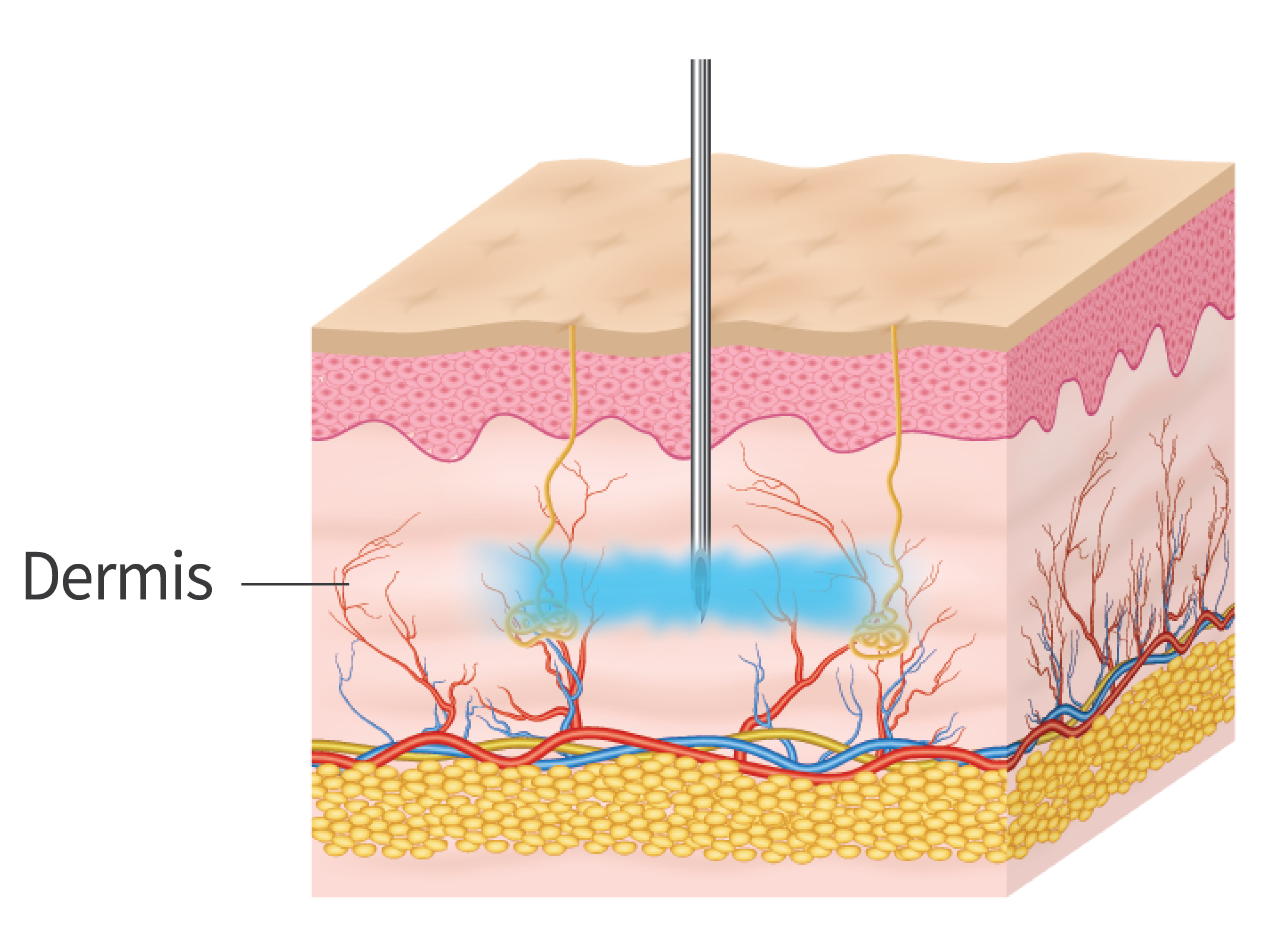 Superficial Stimulator - 19 Needles 0.5 Upper Epidermis